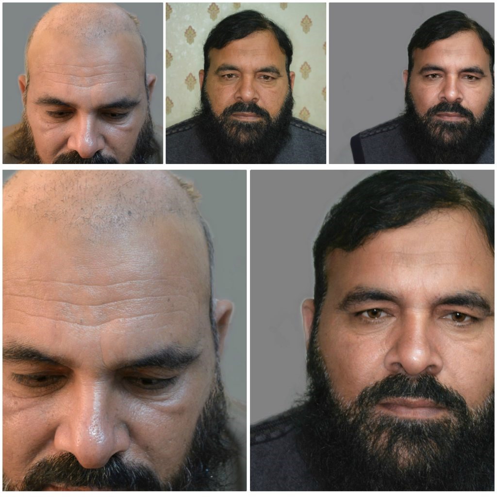 Leading Hair Transplant UK Surgeons – Book a Free Consultation