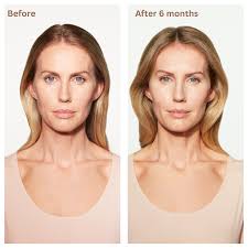 HarmonyCA Treatment for Collagen Stimulation