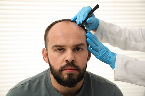 Hair Transplant Turkey Cost Explained by Experts